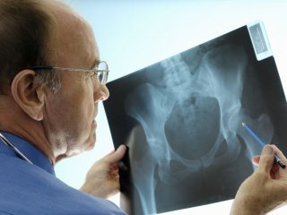 остеопороз на рентгене